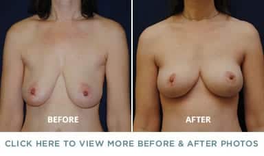 breast lift before after p1