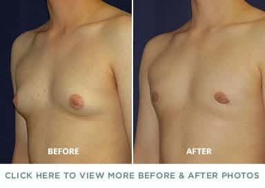young man's chest before and after breast reduction, no breasts after procedure