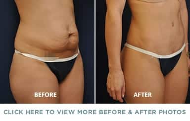 side view of woman’s bare stomach before and after tummy tuck, flatter after operation