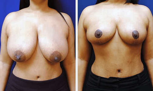 breast reduction img jpg