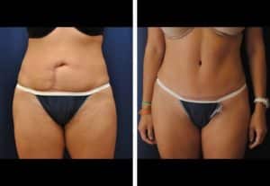 Abdominoplasty Before and After Photos