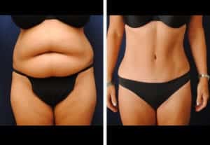 tummy tuck before and after photos