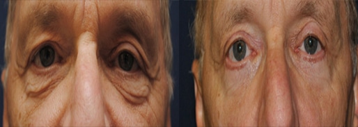 Blepharoplasty Before & After Photos