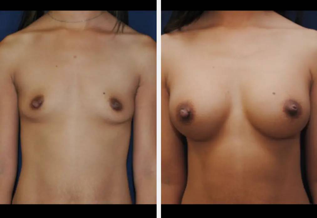 topless woman before and after ideal breast implants, with larger chest after