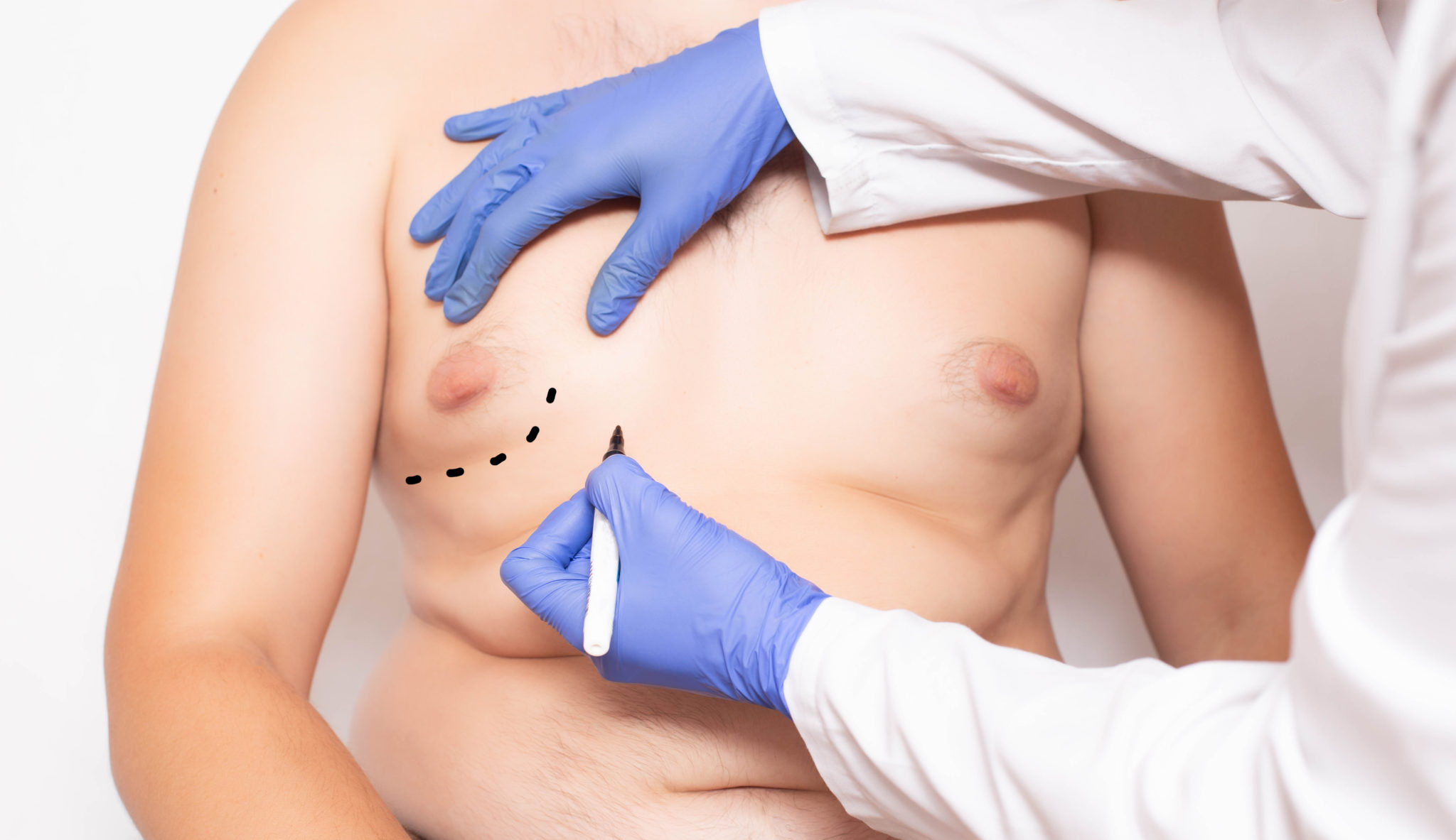 doctor in blue gloves marking overweight male's right breast for surgery