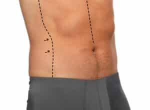 Close-up of man's abdomen with surgical markings, representing cosmetic fat reduction treatments like liposuction and CoolSculpting.