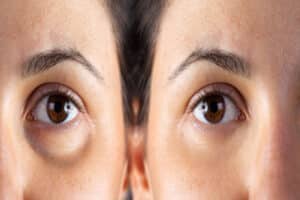 Before and after photo of women who has lower eyelid surgery to address eye bags