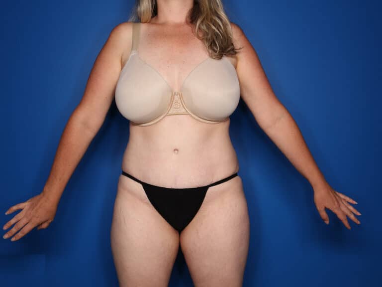 After Image: Abdominoplasty with Saldahna Technique - front