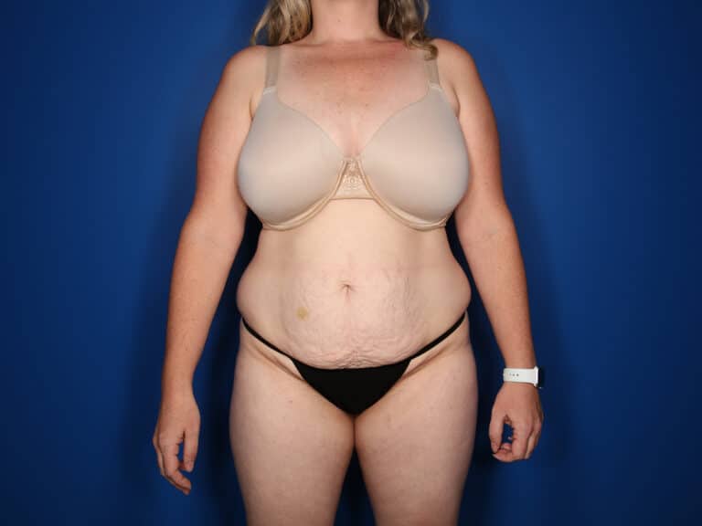 Before Image: Abdominoplasty with Saldahna Technique - front