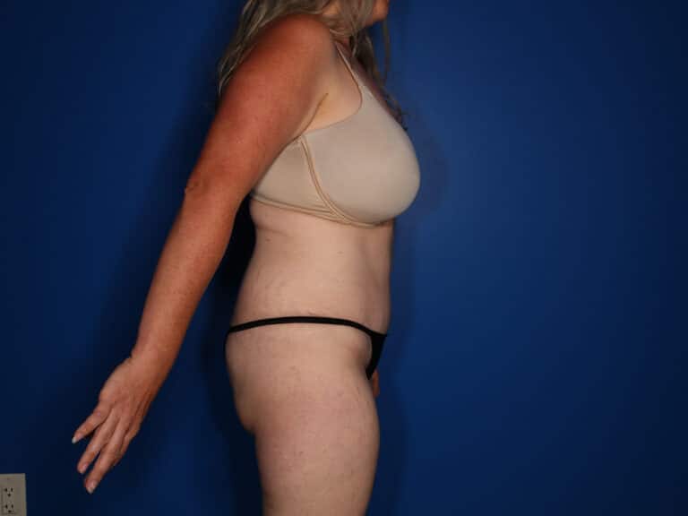 After Image: Abdominoplasty with Saldahna Technique - right-side