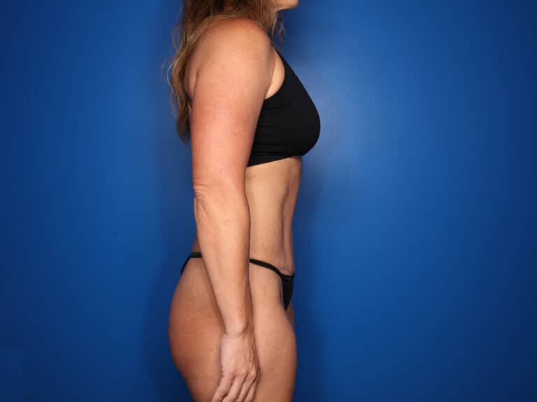 After Image: Abdominoplasty with Saldahna Technique - right-side