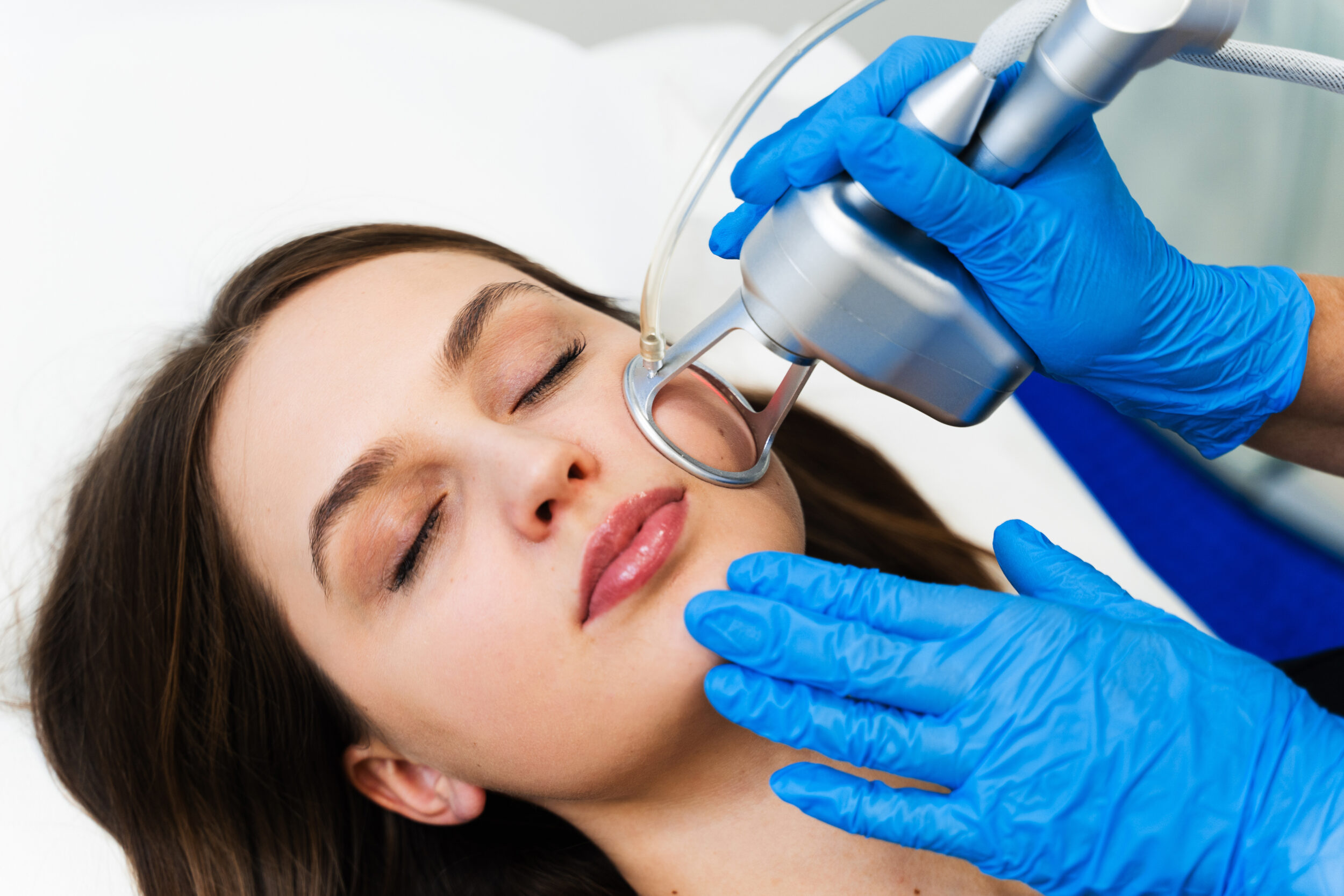 Cosmetologist performing CO2 laser resurfacing on a woman's face to reduce wrinkles and scars.