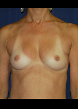 Breast Augmentation – Case 11
