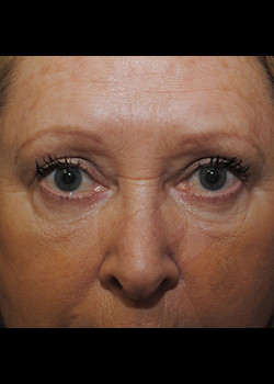 Eyelid Surgery – Case 1