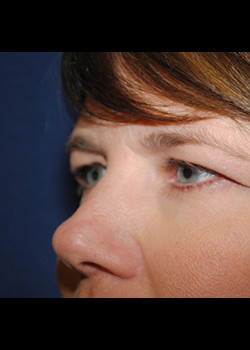 Eyelid Surgery – Case 3