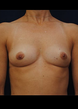 Breast Augmentation – Case 14