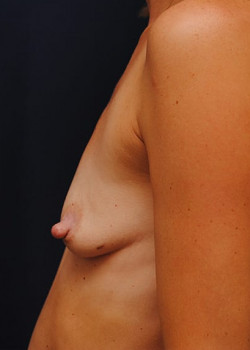 Breast Augmentation – Case 19