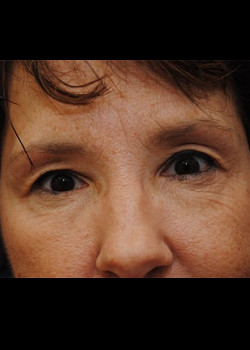 Eyelid Surgery – Case 7