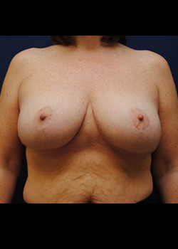 Breast Reduction – Case 1