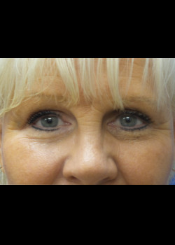 Eyelid Surgery – Case 8