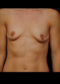 Breast Augmentation – Case 20