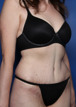Tummy Tuck with Liposuction – Case 31