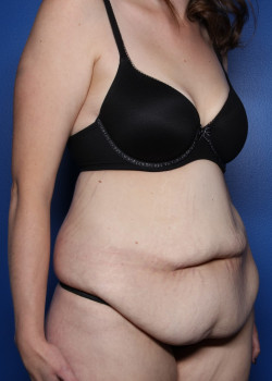 Tummy Tuck with Liposuction