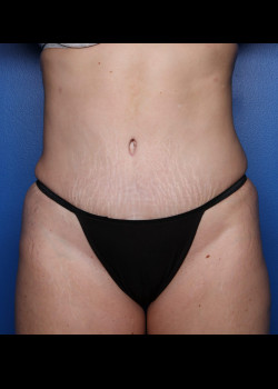 Tummy Tuck With Liposuction
