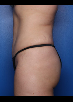 Tummy Tuck With Liposuction – Case 32