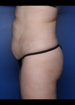 Tummy Tuck With Liposuction – Case 32