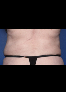 Liposuction – Case 3