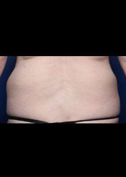 Liposuction – Case 3