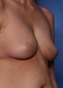 Breast Augmentation with Saline Implants
