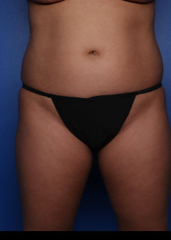Liposuction Of Flanks, Arms, And Abdomen