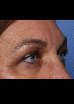Eyelid Surgery – Case 9