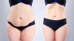 Woman's belly before and after weight loss on gray background